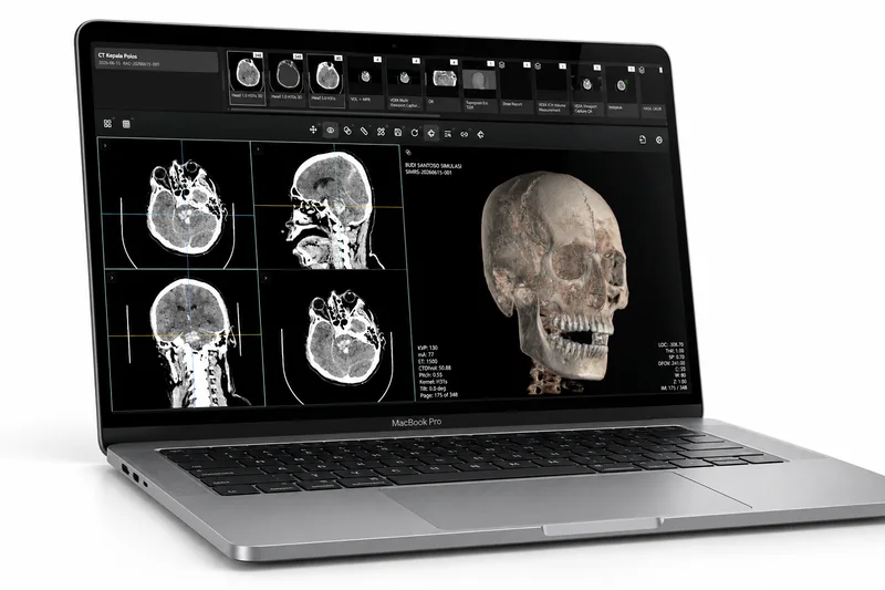 Viewer VEXA PACS berjalan di laptop, menampilkan CT kepala dengan panel rekonstruksi multiplanar dan rendering 3D tengkorak.